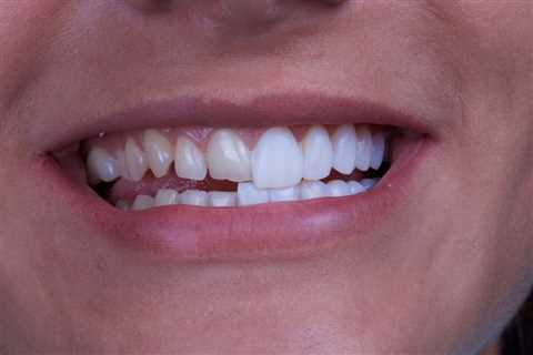 Acacia Dental Group Provides Information on How to Determine If Veneers in Canberra Are Worth It