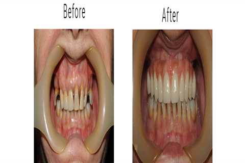 Bexley Dental Explains the Benefits of All on 4 Implants and How They Are Done