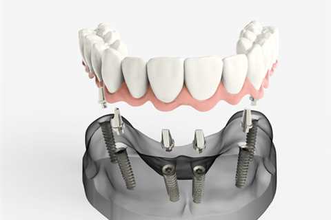 Sydney Dentist Helps Dental Implants Last A Lifetime