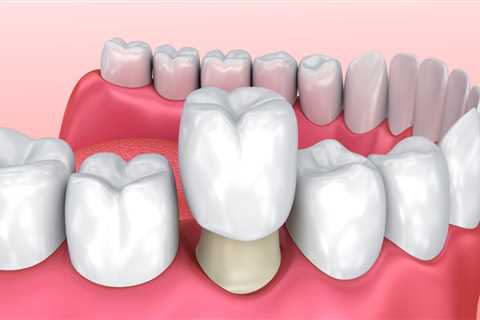 What category does a dental crown fall under?