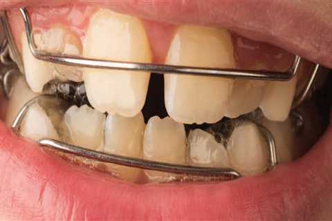 Mixed Dentition: Understanding the Combination of Primary and Permanent Teeth