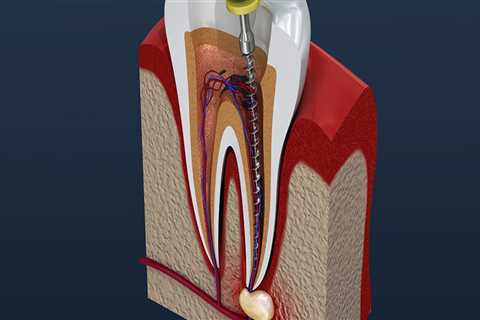 What Foods Should Not Be Chewed With a Bicuspid Tooth?