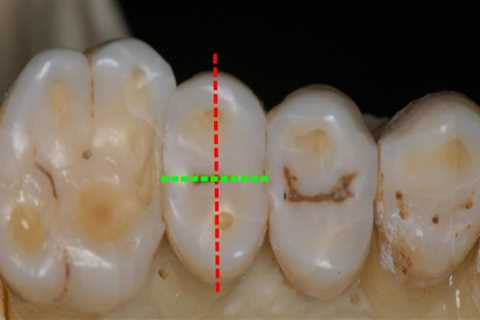 Eating with Primary and Permanent Bicuspids: What You Need to Know