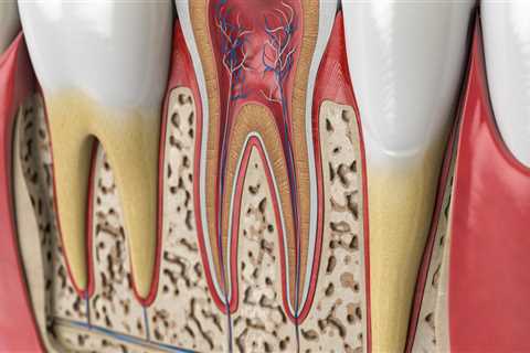 What Happens When a Tooth Infection Reaches the Bone?