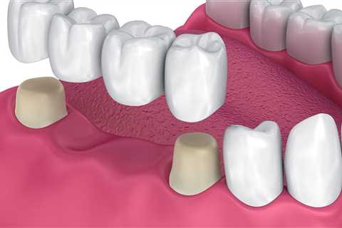 What Supplies are Used to Make Temporary Crowns and Bridges?