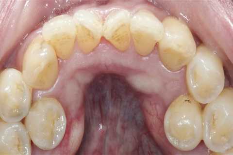 What is the Difference Between a Bicuspid and a Molar Tooth?