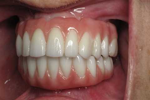 Does the Permanent Dentition Include Total Bicuspids?