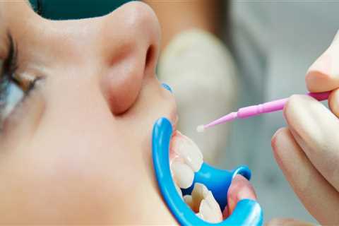 What Supplies Are Used for Dental Sealants and Fluoride Treatments?