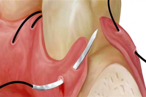 The Most Common Types of Oral Surgery Explained