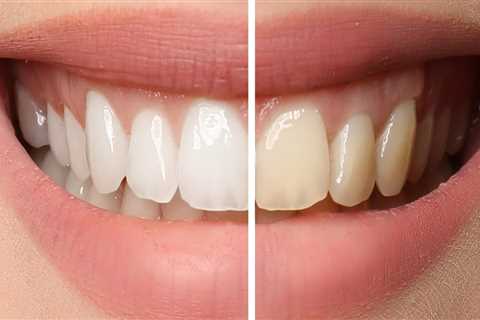 Can I Use Professional Teeth Whitening If I Have Sensitive Teeth?