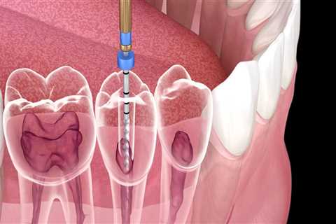 Why an Endodontist is the Best Choice for Root Canal Treatment