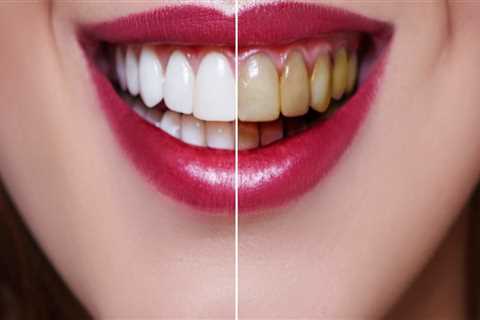 How Often is Too Often for Teeth Whitening? A Professional's Guide