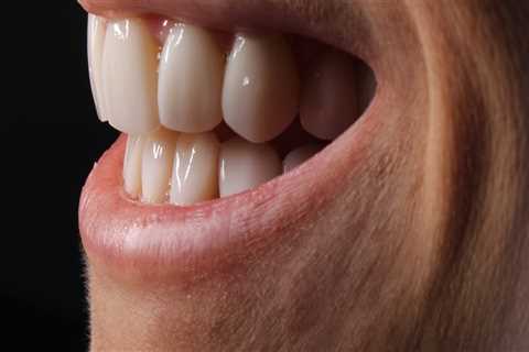 How to Whiten Teeth with Crowns and Veneers