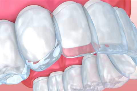 Orthodontic Treatment With Invisalign: What You Need To Know In Austin