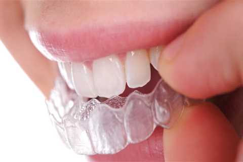 Protecting Your Smile: The Significance Of Dental Safety In Spark Aligners Treatment For London..