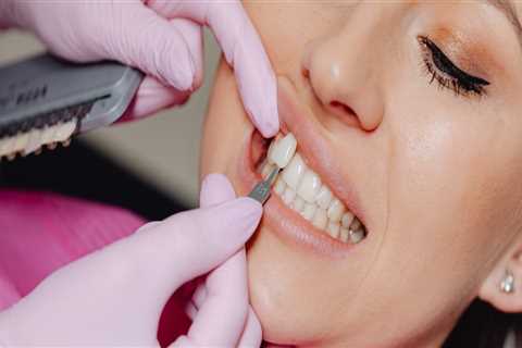 Demystifying Dental Supplies For Teeth Veneers In London: A Patient's Guide