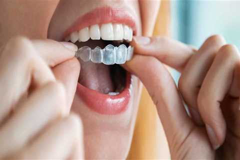 How Spark Aligners Are Used To Treat Various Orthodontic Conditions In London