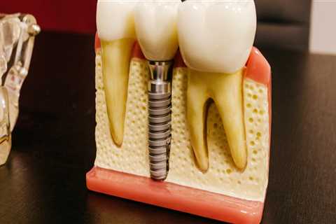 Beyond Chewing: How Bicuspids Contribute To The Success Of Dental Implants In Pflugerville