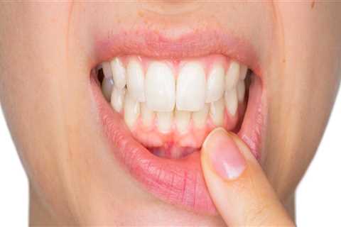 What are the Symptoms of Periodontal Disease?