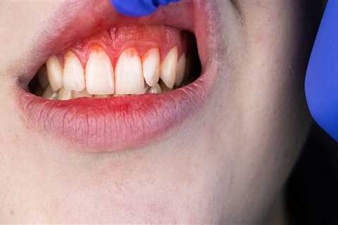 Types of Periodontal Diseases: What You Need to Know