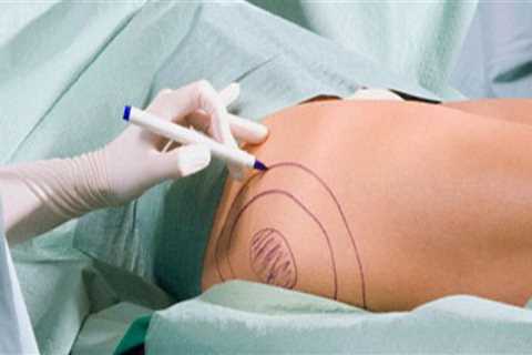 Liposuction Facts From A Health Consultant In Las Vegas