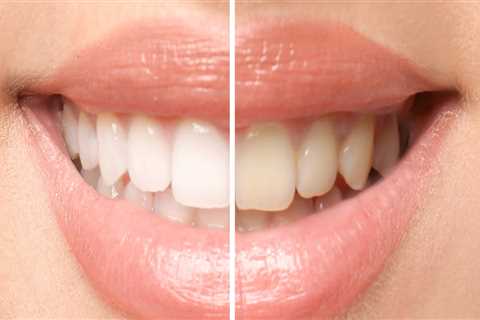 Achieve a Radiant Smile with Teeth Whitening Treatments in Nashville, TN