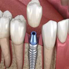 Understanding Periodontics: A Crucial Step Before Dental Implants In Round Rock, TX