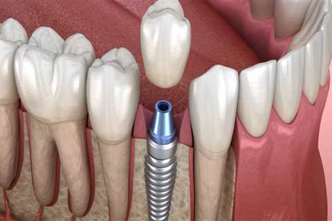 Understanding Periodontics: A Crucial Step Before Dental Implants In Round Rock, TX