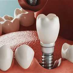 Affordable Full Mouth Dental Implants in Orange County, CA
