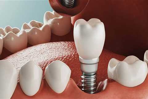 Affordable Full Mouth Dental Implants in Orange County, CA