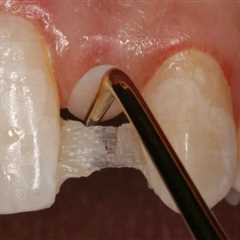 Restore Your Bite: Honolulu Dental Bridges For Missing Bicuspids