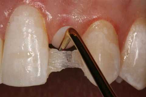 Restore Your Bite: Honolulu Dental Bridges For Missing Bicuspids