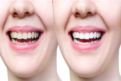 Cracked Or Chipped Bicuspids? Why Immediate Care From An Ashburn Dentist Is Important