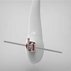 Understanding Bicuspids and Braces: Expert Orthodontic Care in Fort Walton Beach