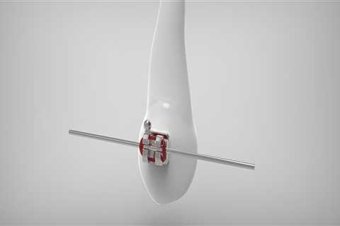 Understanding Bicuspids and Braces: Expert Orthodontic Care in Fort Walton Beach