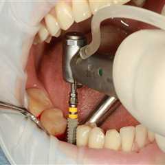 Enhance Orthodontics with Tooth Implants in North Little Rock