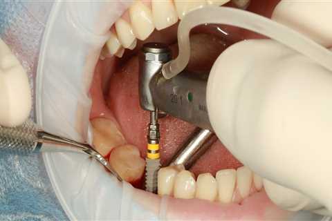 Enhance Orthodontics with Tooth Implants in North Little Rock